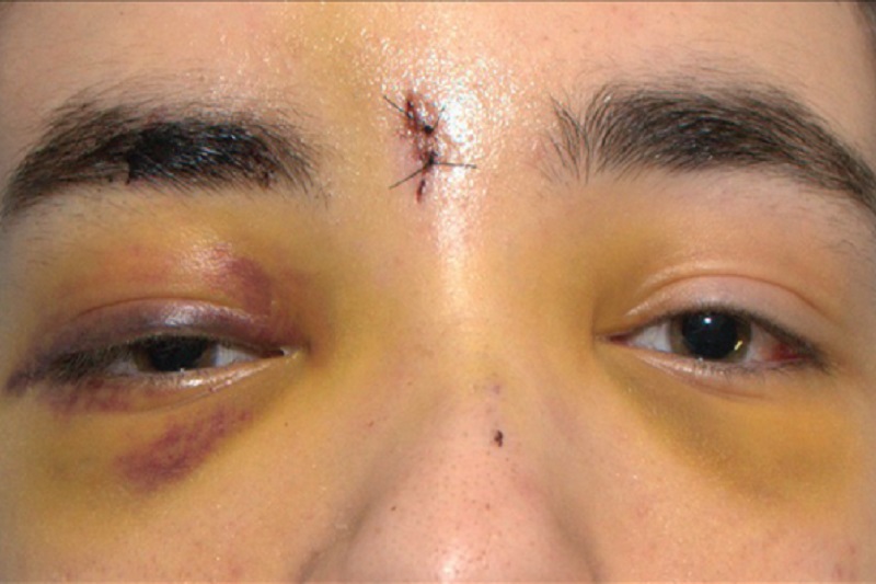 Orbital Fracture Surgeries